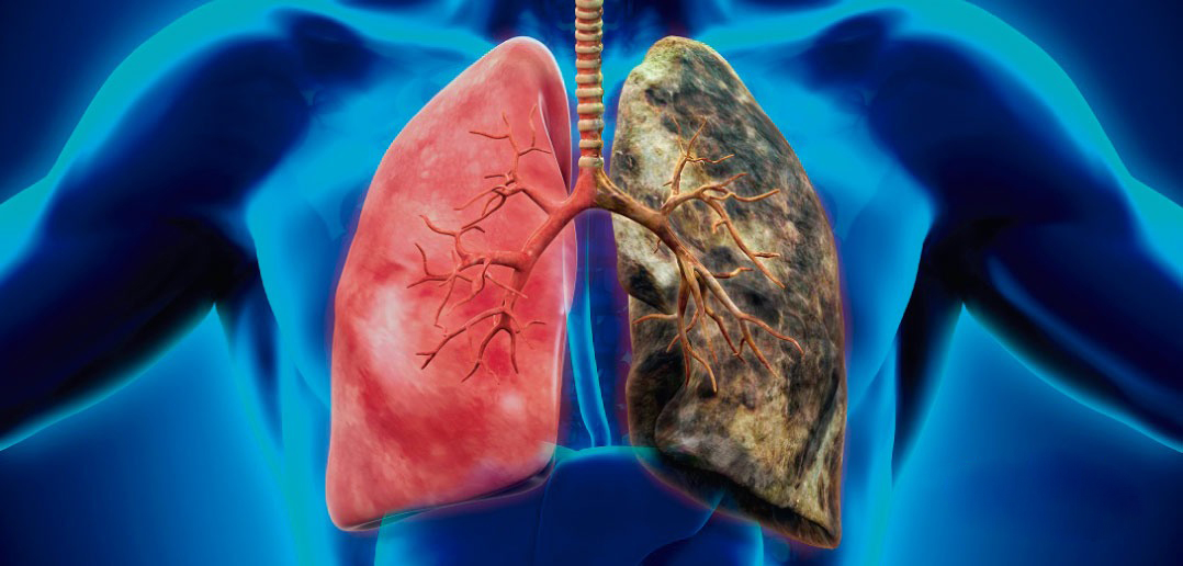 Lee más sobre el artículo Acelerando el diagnóstico de cáncer de pulmón y su análisis molecular a través de las biopsias líquidas